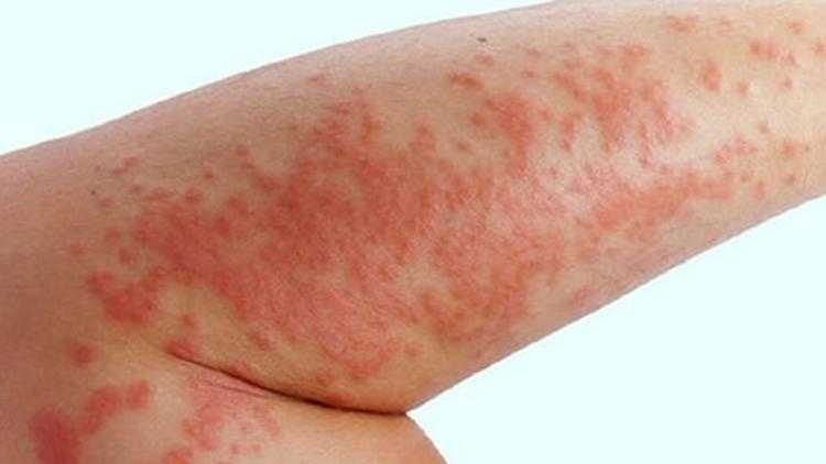Cilt Hastalıkları Uzmanı ve Dermatit 